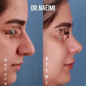 نمونه کار جراحی بینی گوشتی در مشهد _ دکتر محمد نعیمی