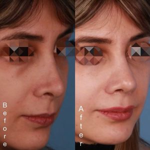 قبل و بعد جراحی بینی ترمیمی _ پرفسور محمد نعیمی