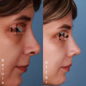 نمونه کار جراحی بینی ترمیمی در مشهد توسط دکتر محمد نعیمی