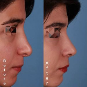 نمونه کار عمل بینی ترمیمی _ پروفسور محمد نعیمی 