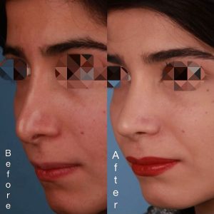 قبل و بعد عمل بینی ترمیمی در مشهد _ پروفسور محمد نعیمی